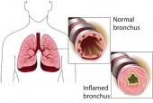 Link Between Eczema &amp; Asthma