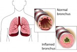 link-between-eczema-asthma