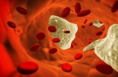 Why Lowering Your Cholesterol Won't Prevent Heart Disease