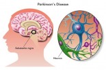 New Treatments for Parkinson&#039;s Disease