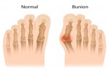 Battling Bunions: What REALLY Happens During Surgery