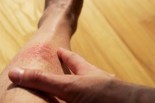 what-causes-eczema