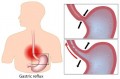 Nexium & Prilosec Insight: How Common Are these Drugs?