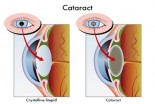 Dear Doctor: What Is a Cataract?